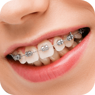 Sonrisa con brackets